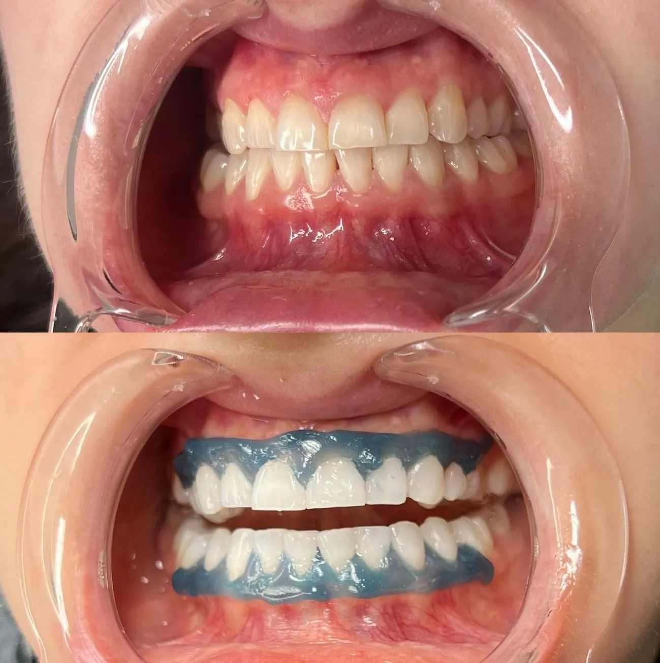 Kankens Australia | What Do Dentists Use to Whiten Teeth? How to Keep Your Teeth White for Longer