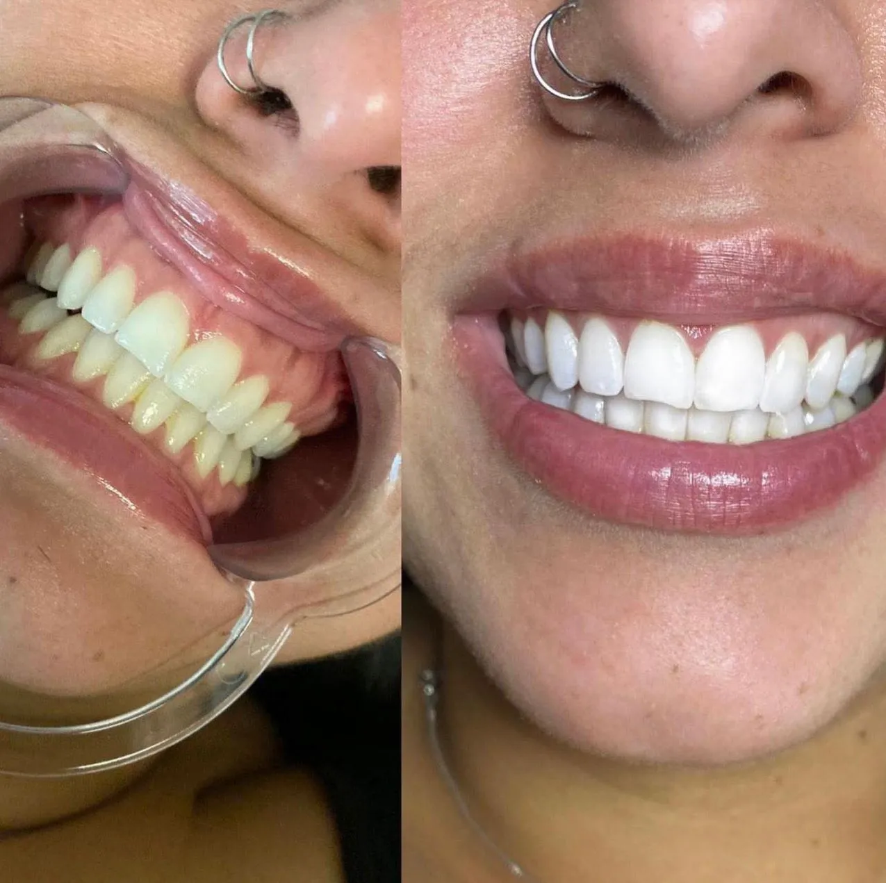 Kankens Australia | What Do Dentists Use to Whiten Teeth? Is It Safe (And What Are the Risks)