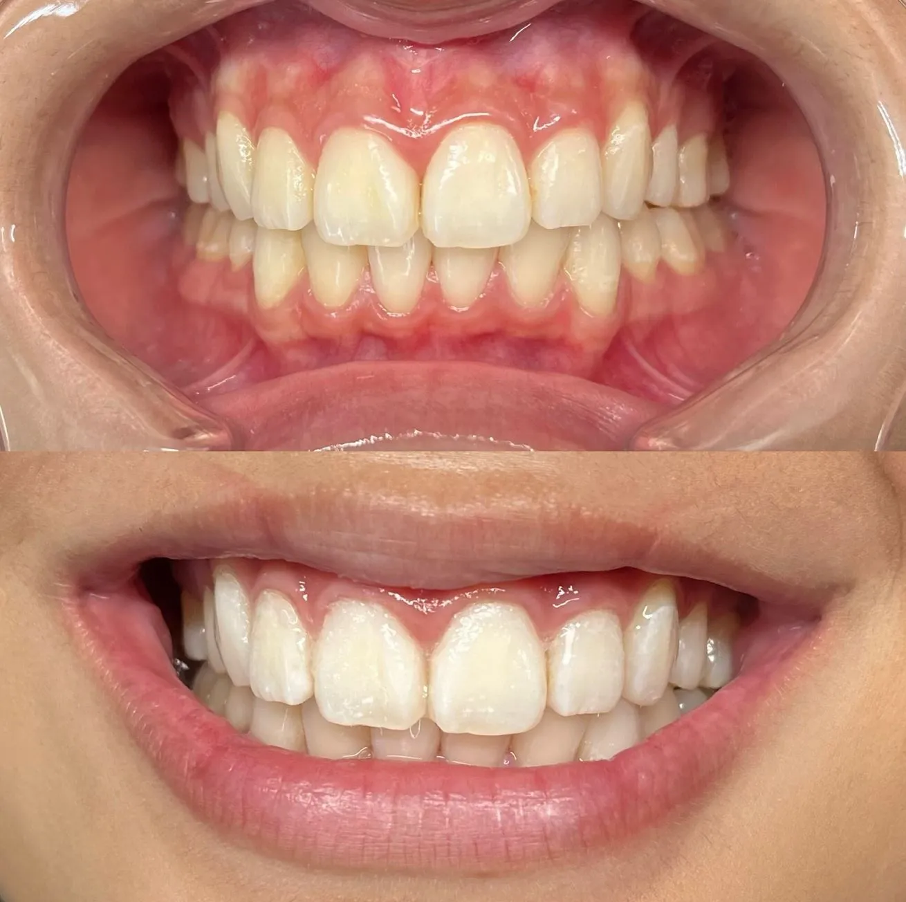 Kankens Australia | What Do Dentists Use to Whiten Teeth? The Professional Secret