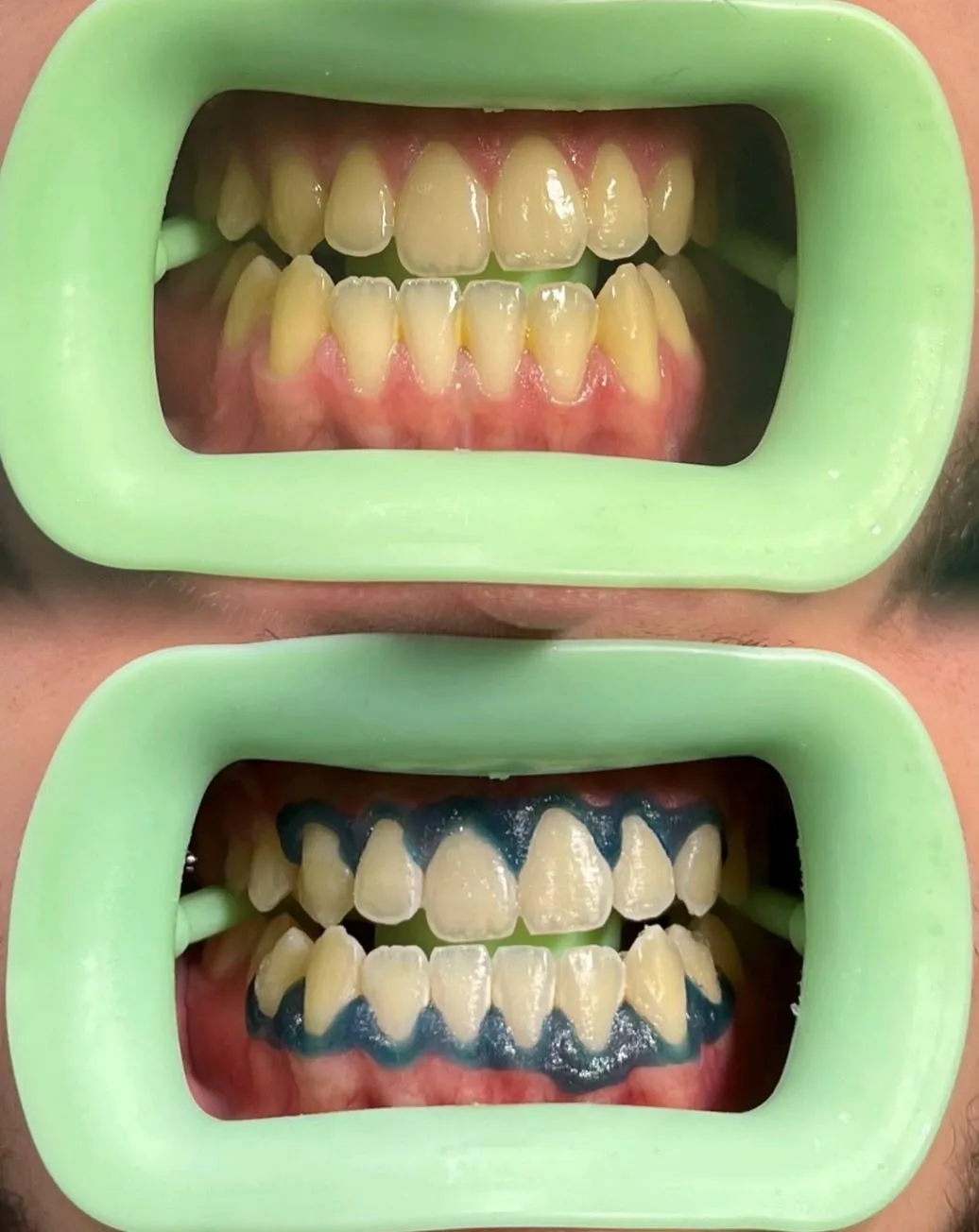 What Do Dentists Use to Whiten Teeth